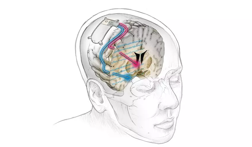 Pierwszy na świecie implant mózgu skutecznie leczy uporczywą depresję u pacjenta