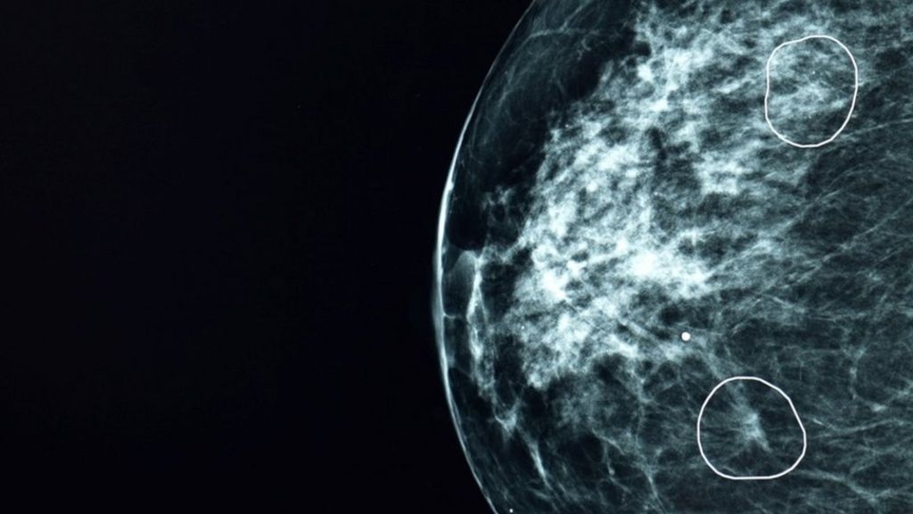 W Wielkiej Brytanii sztuczna inteligencja pomogła wykryć przypadki raka piersi przeoczone przez lekarzy